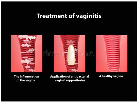 Sexe vaginal classique Escorte Onex